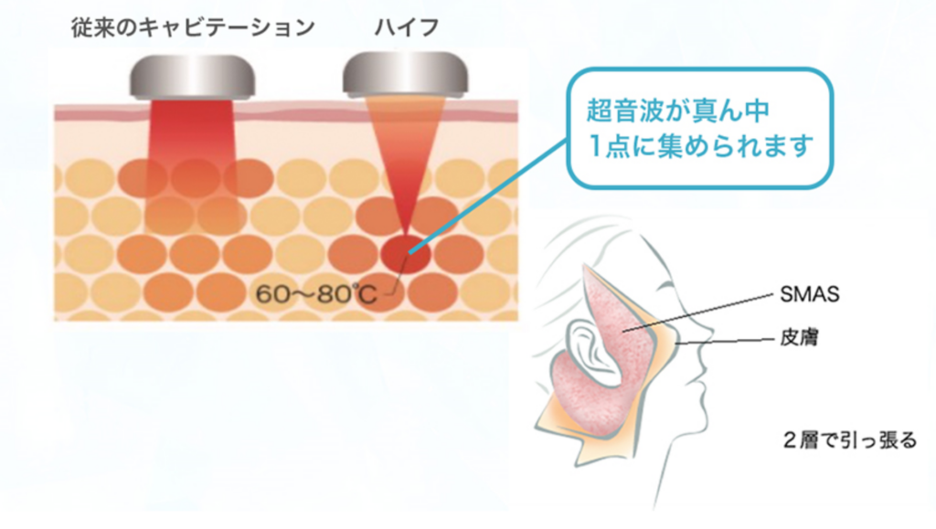 HIFU | VFr Beauty Clinic